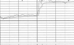 涨停板手法的分析概述